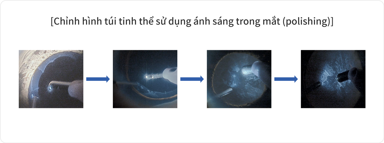Chỉnh hình túi tinh thể sử dụng ánh sáng trong mắt (polishing)