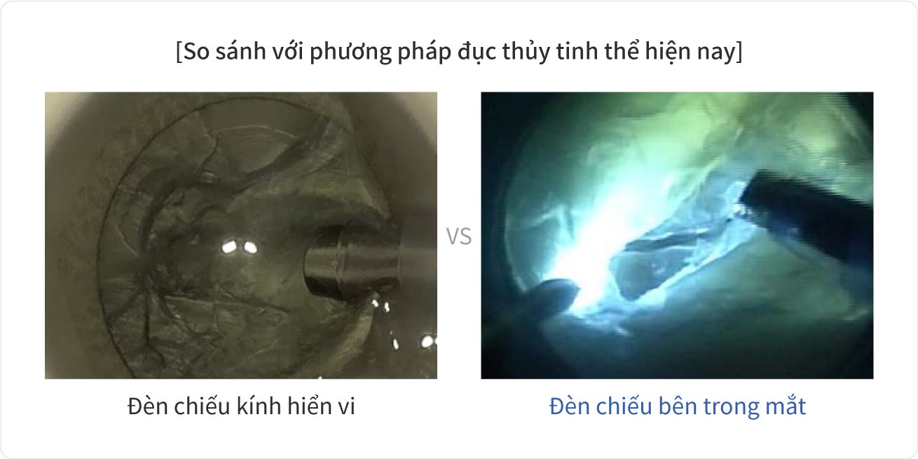So sánh với phương pháp đục thủy tinh thể hiện nay